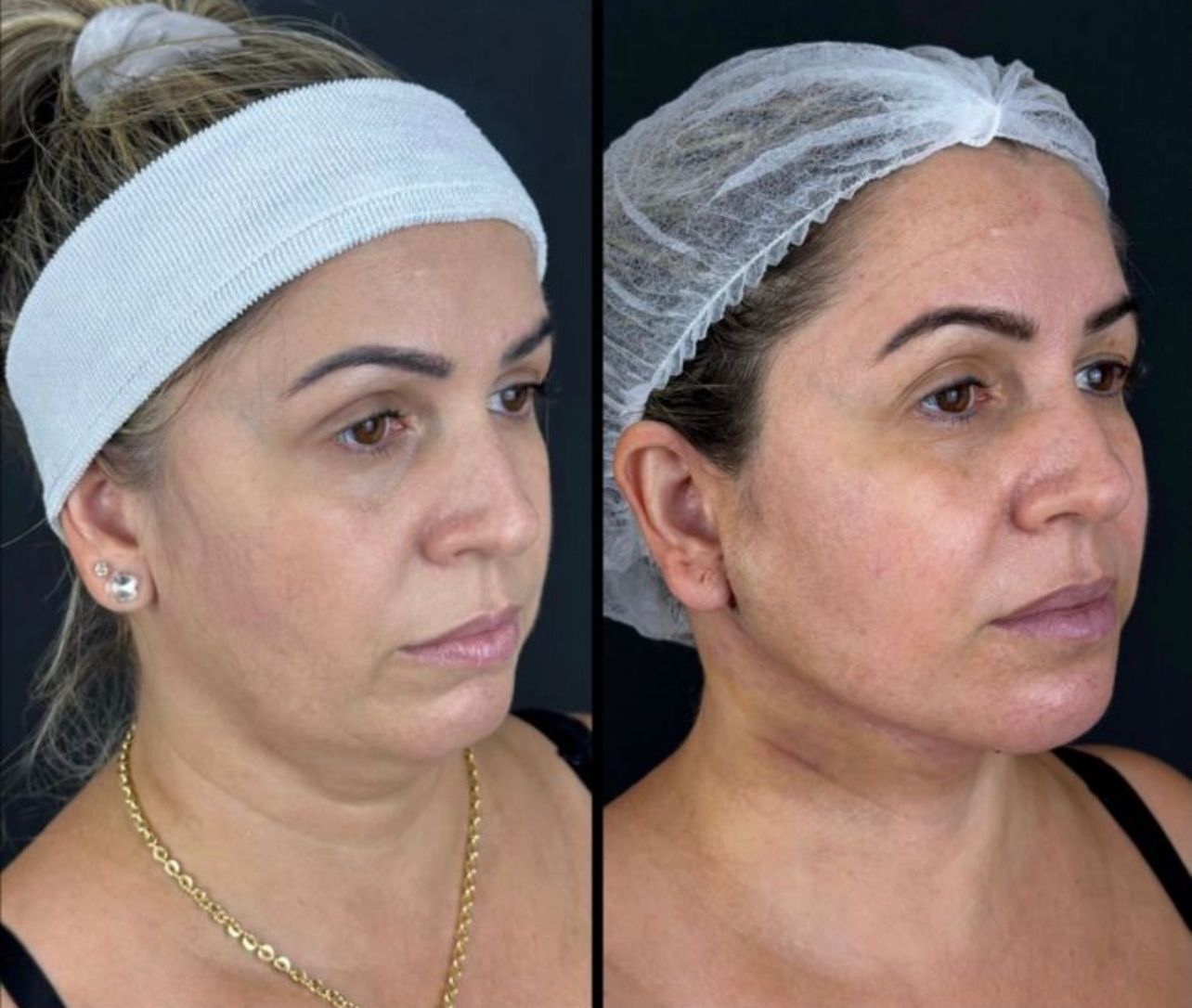 lipo de papada feminino 2