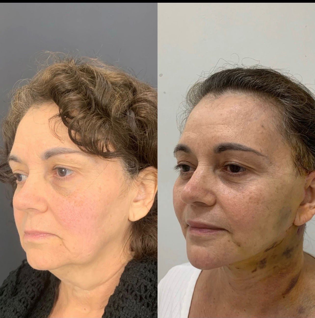 lipo de papada feminino